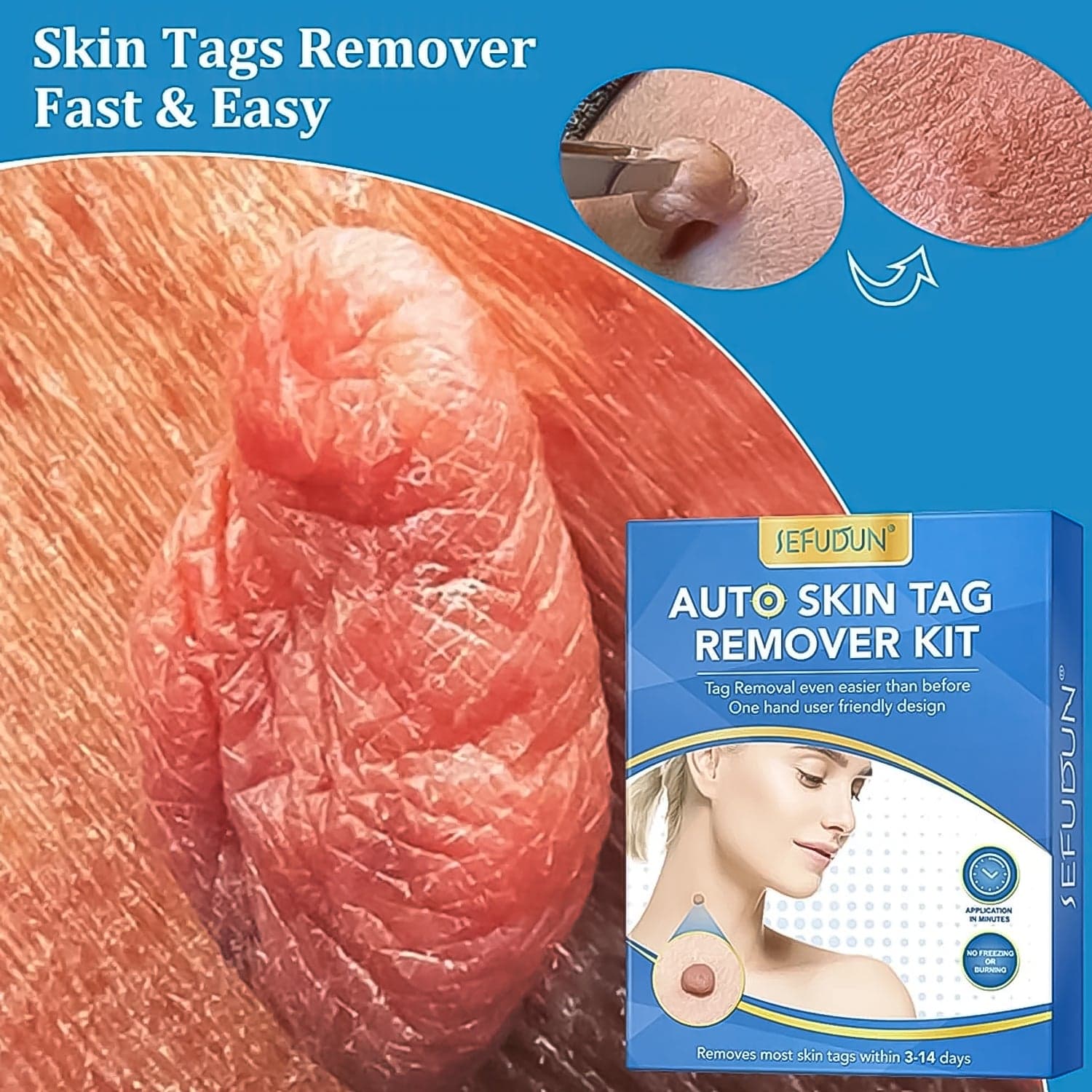 Skin Tag Remover Kit 2 in 1 for Micro to Large (2 mm - 8 mm / 1 Set) thumbnail 4