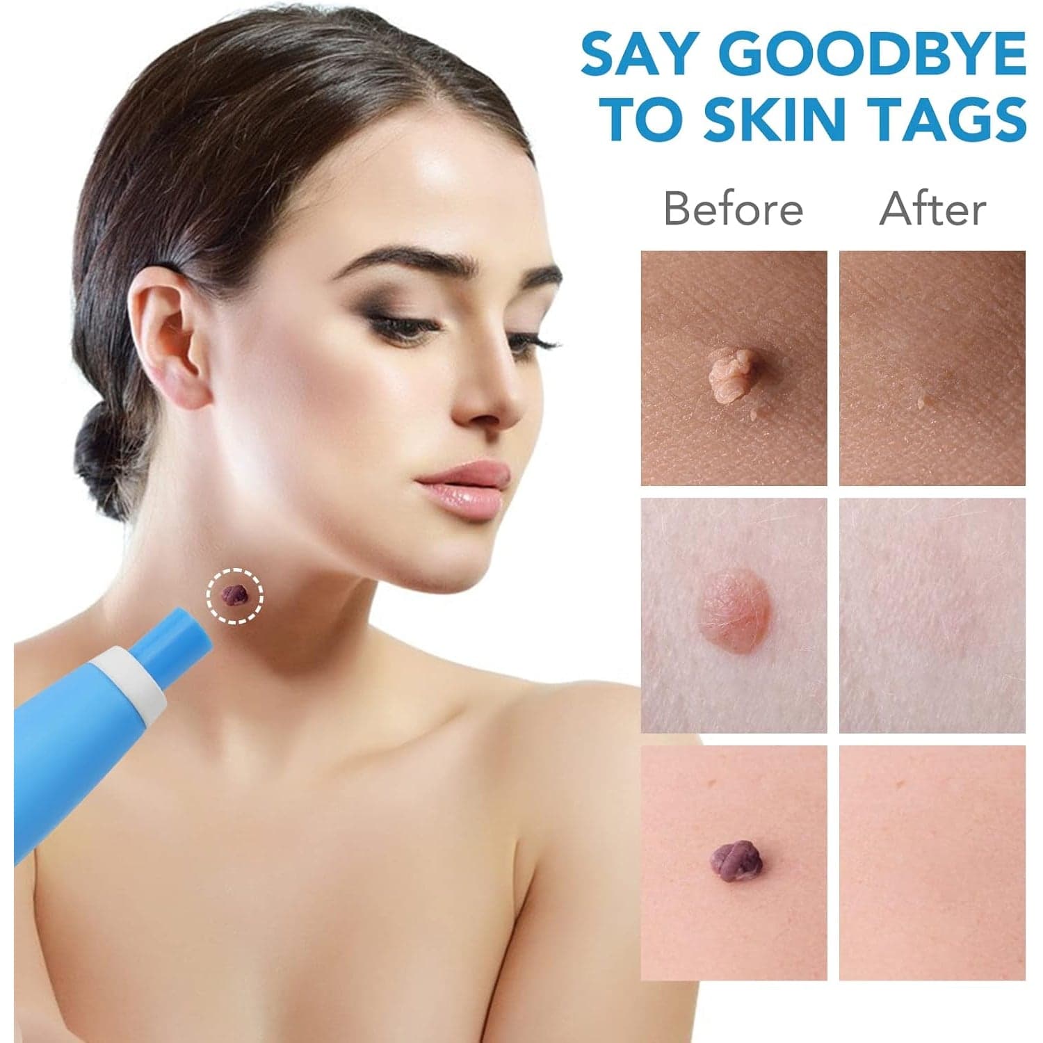 Skin Tag Remover Kit 2 in 1 for Micro to Large (2 mm - 8 mm / 1 Set) thumbnail 6